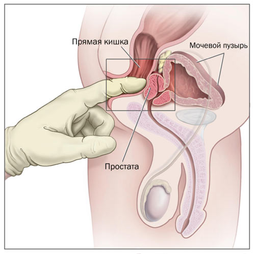 Как сделать массаж простаты мужу дома kak-sdelat-massazh-prostaty-muzhu-doma