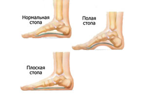 Как вылечить плоскостопие kak-vylechit-ploskostopie