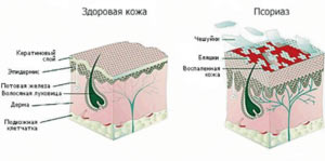 Лечение псориаза на теле lechenie-psoriaza-na-tele