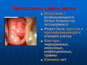 Лейкоплакия шейки матки - что это такое lejkoplakiya-shejki-matki-chto-ehto-takoe