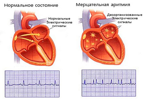 Мерцательная аритмия сердца лечение народными средствами mercatel'naja_aritmija_serdca_lechenie_narodnymi_sredstvami