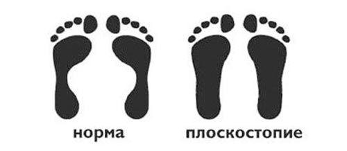 Основные симптомы плоскостопия osnovnye-simptomy-ploskostopiya