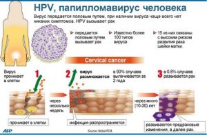 Папилломавирусная инфекция как лечить papillomavirusnaya-infekciya-kak-lechit