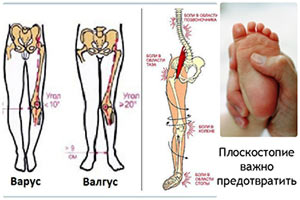 Плоскостопие у детей последствия ploskostopie-u-detej-posledstviya