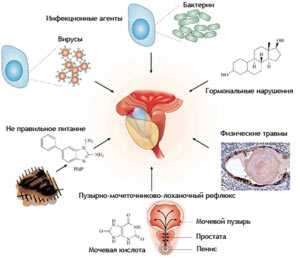Причины возникновения простатита у мужчин prichiny-vozniknoveniya-prostatita-u-muzhchin