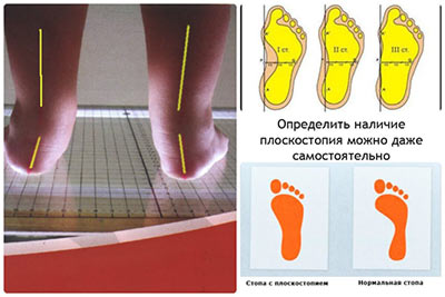 Признаки плоскостопия у детей priznaki-ploskostopiya-u-detej
