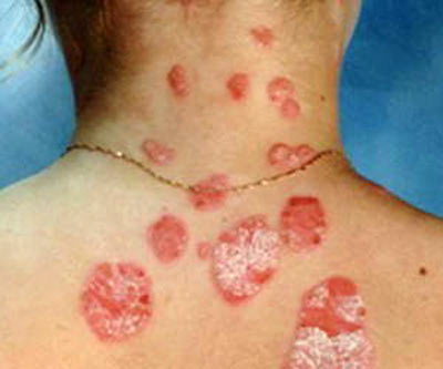 Псориаз передается по наследству psoriaz-peredaetsya-po-nasledstvu