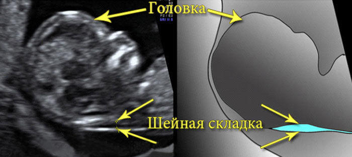Синдром Дауна признаки на УЗИ sindrom-dauna-priznaki-na-uzi