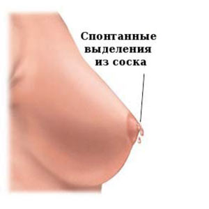 Выделения из молочных желез при надавливании vydeleniya-iz-molochnyh-zhelez-pri-nadavlivanii